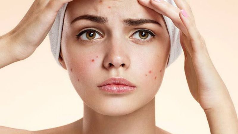 Cách trị mụn trứng cá tại nhà hiệu quả Mụn là vấn đề khiến nhiều người đau đầu